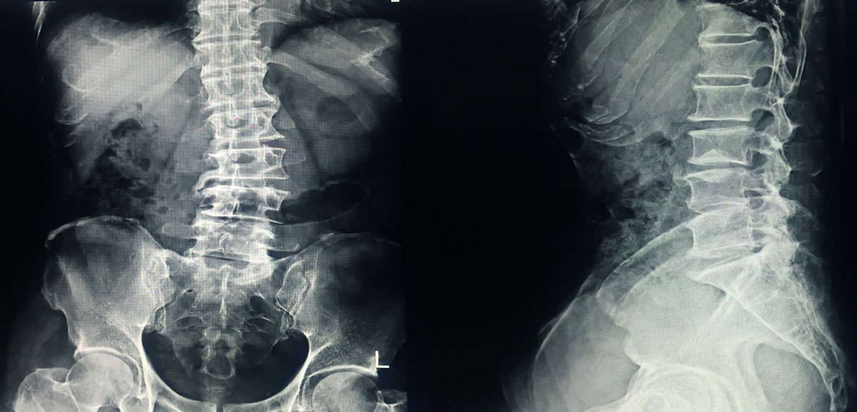 x-ray of a spine afflicted with scoliosis